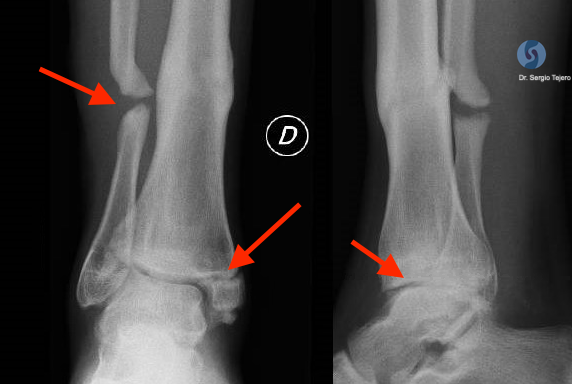 1.Secuela de fractura previa y artrosis