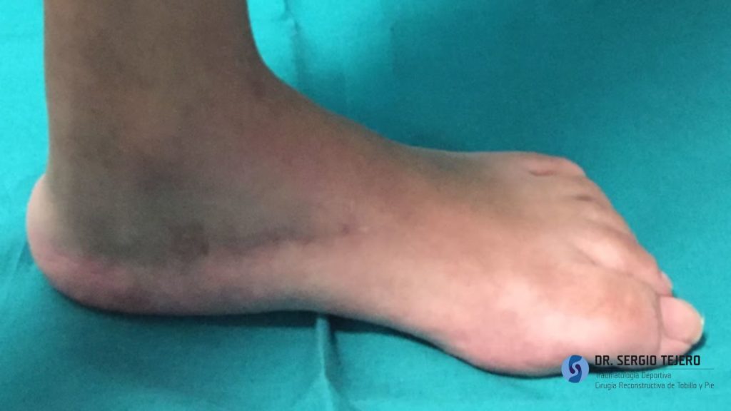 Tratamiento Enfermedad de Charcot-Marie-Tooth
